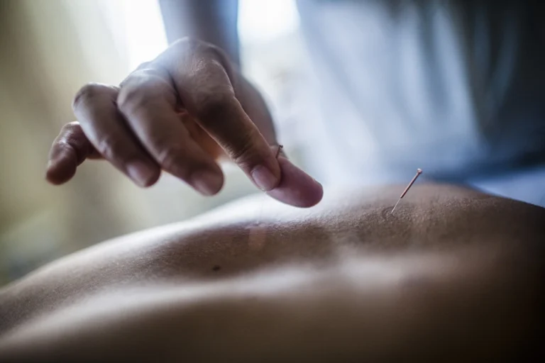 acupuntura zaragoza